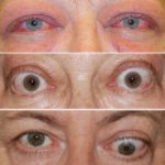 Grejvsova oftalmopatija