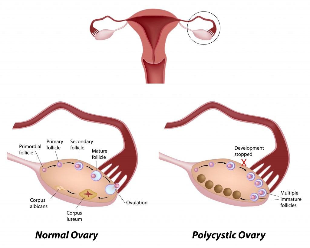 PCOS